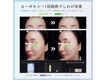 フレア(FULEA)/カーボキシー高濃度炭酸パック