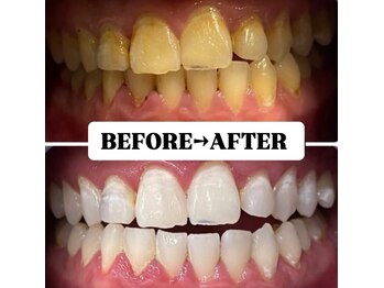ホワイトニングサロン 豊中/Before&After美白ホワイトニング