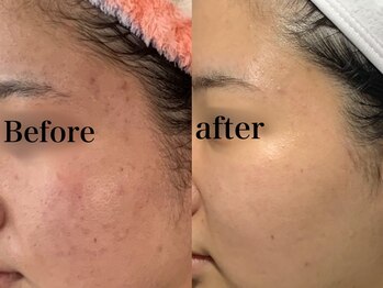 ヒール(heal)/症例