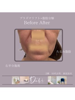 デフィ(Defi)/プラズマリフト×脂肪分解