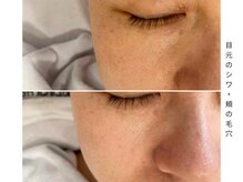 コンビンス(convince)/たるみ・シワ改善フェイシャル