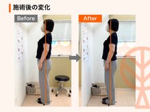 ただき接骨院 整体院 高崎本院/施術後の変化：反り腰