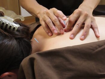 さっぽろ心灯はり きゅう院/ハリスリム 札幌山鼻(Hari-Slim)の写真/既に口コミ多数☆結果重視の最短ダイエット!鍼灸を使った負担のない最新痩身◎初回¥3980-カウンセリング付