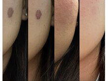 最短１回で剥がせる最新シミケア／ホワイトラボ正規取扱店