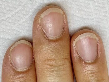 ネイルルーム エンヌ(nail room en'ne)の写真/爪が薄い/深爪/二枚爪/平爪etc.爪を綺麗にしたい方に◎画像は1枚目のビフォーになります！