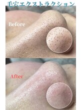 ボータン 恵(Beau Temps)/毛穴ケア/毛穴洗浄　【施術例】