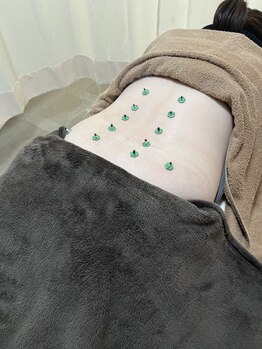 まごころ整骨院/お灸施術