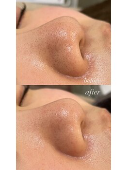 フェリーチェ(FELICE)/毛穴洗浄フェイシャル￥7,500