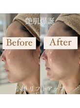 クリニカルホワイトケア 和泉府中店(クリニカルWHITEケア)/人気の小顔メニュー