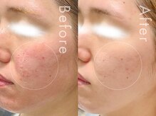 セルフミー 恵比寿(SELF Me...)/ハーブピーリング/ニキビケア