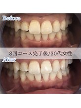 ホワイトニングカフェ 藤が丘店(WhiteningCafe)/8回コース完了後☆