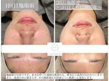 ラヴィオーラ 明石店(La Viora)/ダイヤモンドハーブピーリング