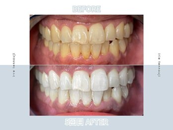 アイリー ホワイトニング 難波店/ホワイトニングビフォーアフター