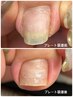 【継続クーポン】以前、印田モニター様になって下さった方限定★巻き爪ケア★