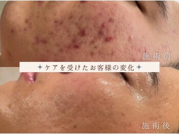 アンパウマン(Anpawman)/ハーブピーリング10回 症例