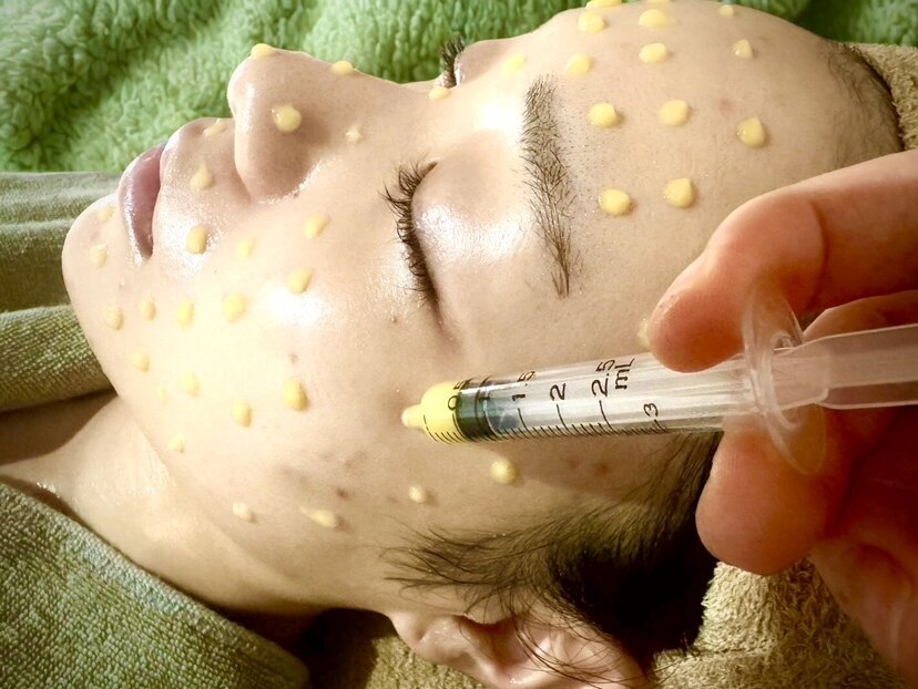 【レチノールマイクロニードルコース】毛穴開き・たるみケア・ほうれい線