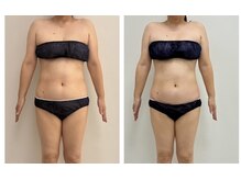 ミルティー(Myrtille)/痩身前におすすめ/リンパ解放術