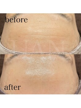 ルアナ(LUANA)/おでこのしわシワ改善！