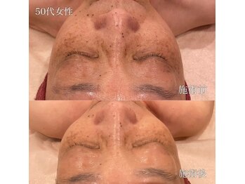 ナンバー19(N°19)/ハーブピーリングで部分ケア☆