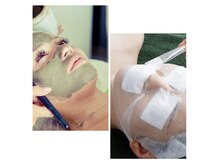 全員/お悩み別お肌質別ピーリング×毛穴洗浄×パック×LDM\9900