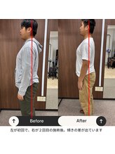 ルピナス整体院/姿勢ビフォーアフター（横）