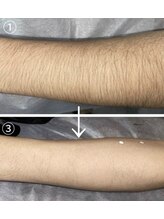 完全都度払い 明石メンズ脱毛/before/after 腕3回目