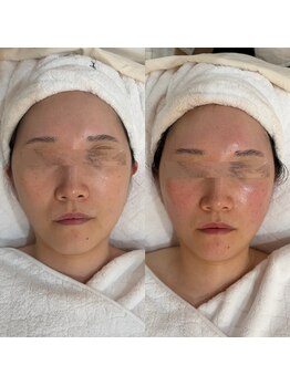 エクリア(Eclia)の写真/NEWOPEN★長年解消しなかった毛穴汚れ/黒ずみ/開きに◎プロの施術で毛穴レス&滑らかな肌へ♪