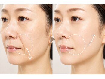 ティアラ(TIARA)の写真/お顔の表情筋を鍛えるケアで理想のフェイスラインへ！ダウンタイムなしのエイジング☆