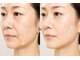 ティアラ(TIARA)の写真/お顔の表情筋を鍛えるケアで理想のフェイスラインへ！ダウンタイムなしのエイジング☆