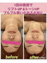 リッシュ(RICHE)/毛穴洗浄スペシャルコース