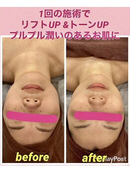 リッシュ(RICHE)/毛穴洗浄スペシャルコース
