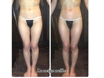 ラネージュミル(La neige mille)/インキュア痩身