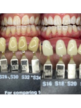 トウキョースワーズ 渋谷店(TOKYO SWRS)/#ホワイトニング #渋谷 #池袋