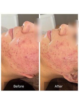 ビビ(VIVI)/ララピールとハーブピーリング