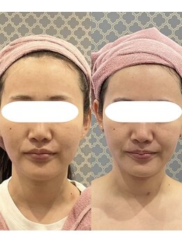 パリスヒロトン(PARIS HIROTON)/セルドライブフェイシャル