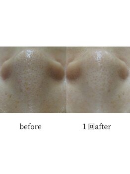 アップルミント/＜フェイシャル＞before・after