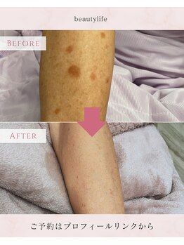 ビューティーライフ(beauty life)/韓国最新シミケア