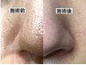 【新規【大人気★ハイドロ】毛穴洗浄で黒ずみザラつきリセット　8,800円　