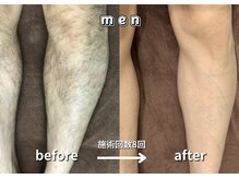 キュー(cue)/【メンズ】「脚脱毛」施術事例