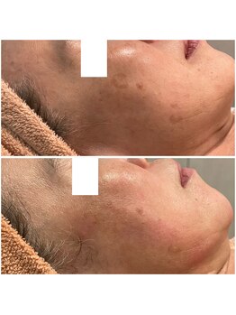 リッツ ひばりが丘パルコ店/【Before/After】しみ改善