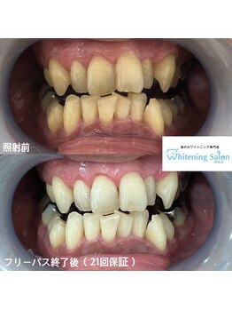 ホワイトニングサロン 熊本店/誰でもホワイトニング