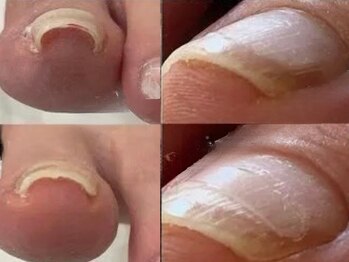 レイネイル レイアイ イオンナゴヤドーム前店の写真/巻き爪矯正だけじゃない★ジェルネイルもできる画期的メニュー新登場♪巻き爪のお悩みから解放&お洒落も◎