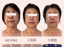 アンリール(Anrire)/【板橋/フェイシャルエステ】