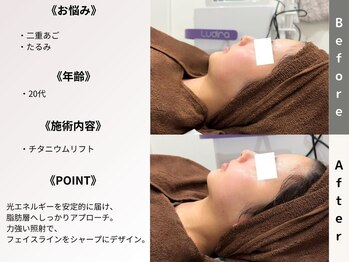 ルディラ 渋谷店/チタニウムリフト