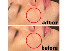 ブルーム(BLOOM)/REVI陶肌トリートメント