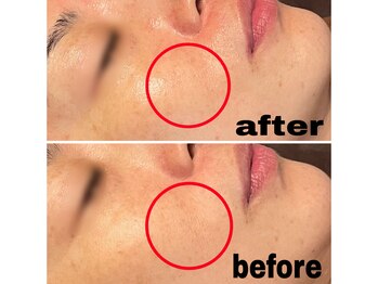 ブルーム(BLOOM)/REVI陶肌トリートメント