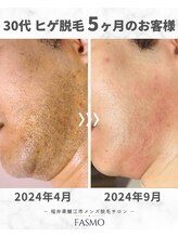ファスモ(FASMO)/30代 / ヒゲ脱毛 / 5ヶ月目