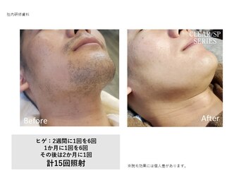 ロミオワックス ジュリエットワックス 新宿店(ROMEO Wax Juliet Wax)/髭脱毛/光脱毛ビフォーアフター