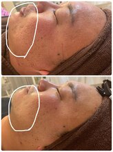 ル シェリア(Le Cherien)/ハーブで肌質改善