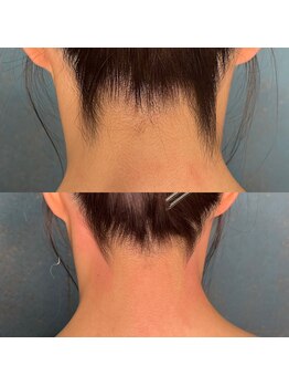 シュシュ 梅田店(+Chou chou)/うなじ脱毛